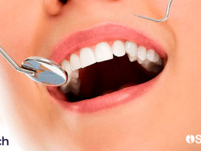 Desarrollan un hidrogel anticaries que blanquea los dientes sin dañarlos